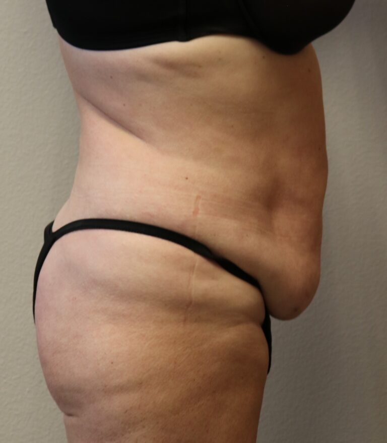 Before Image: Tummy Tuck - right-side