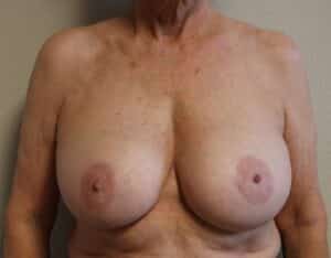Before Image: Breast Implant Removal