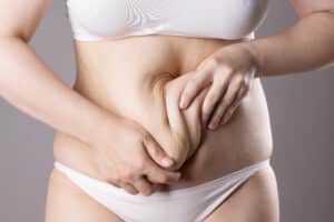 Woman pulling at loose skin on her stomach after weight loss