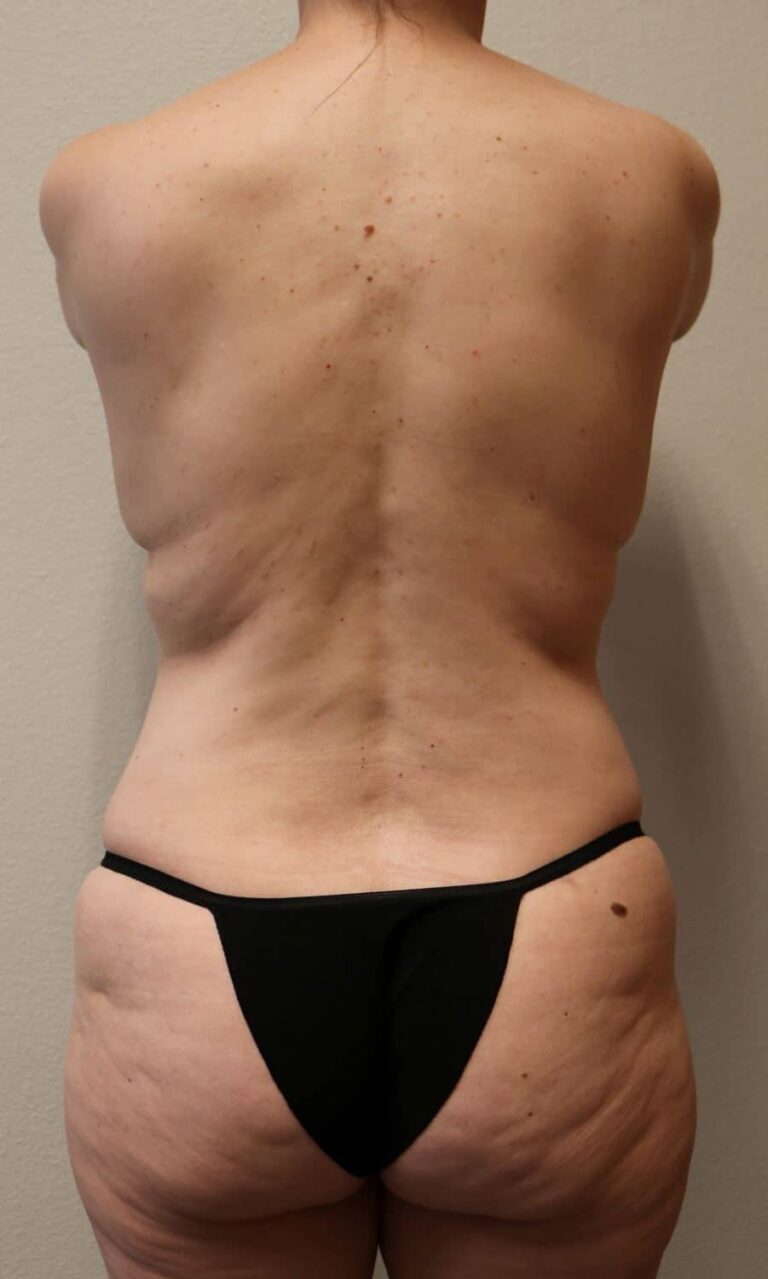 After Image: Tummy Tuck - back