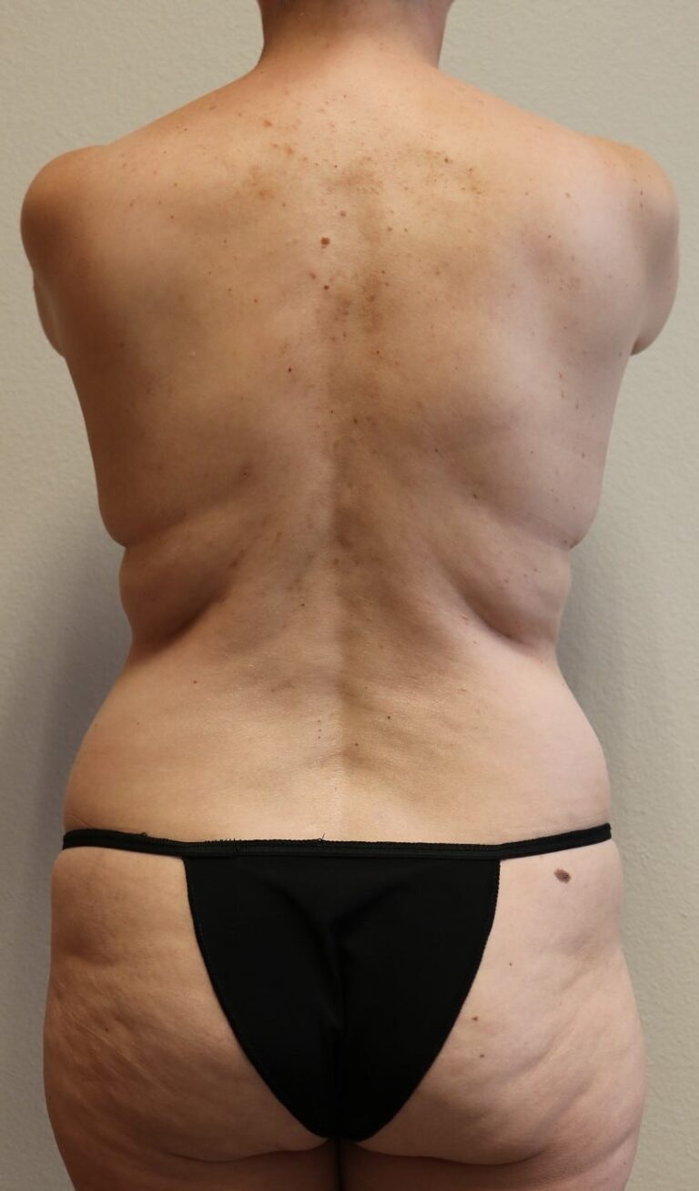 Before Image: Tummy Tuck - back