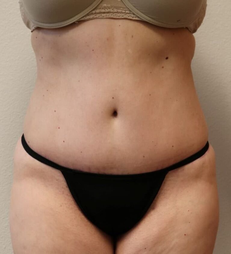After Image: Tummy Tuck - front