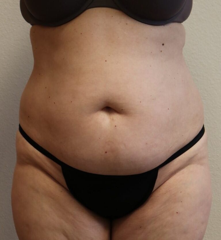 Before Image: Tummy Tuck - front