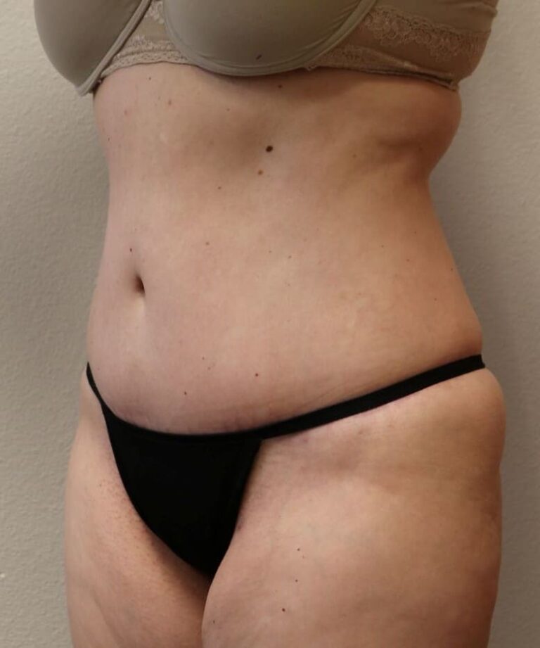 After Image: Tummy Tuck - left-front-oblique