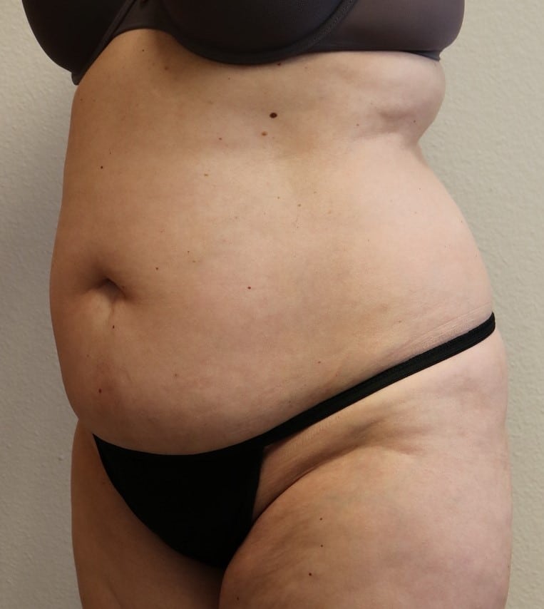Before Image: Tummy Tuck - left-front-oblique