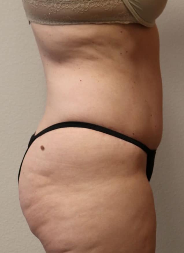 After Image: Tummy Tuck - front