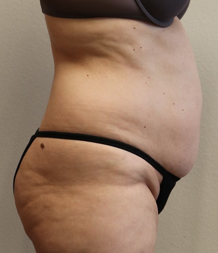 Before Image: Tummy Tuck - front