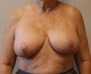 After Image: Breast Revision – Fort Worth