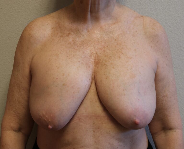Before Image: Breast Revision – Fort Worth - front