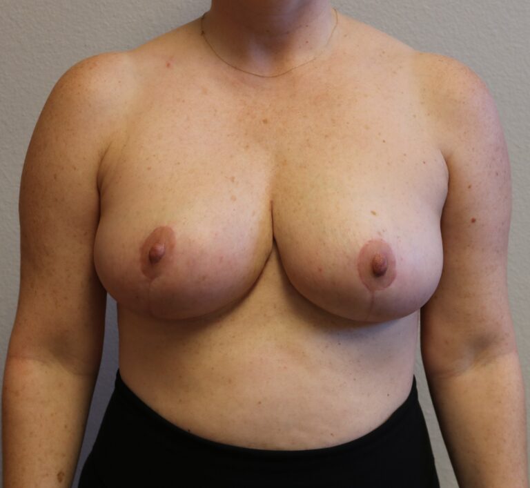 After Image: Breast Reduction – Fort Worth - front