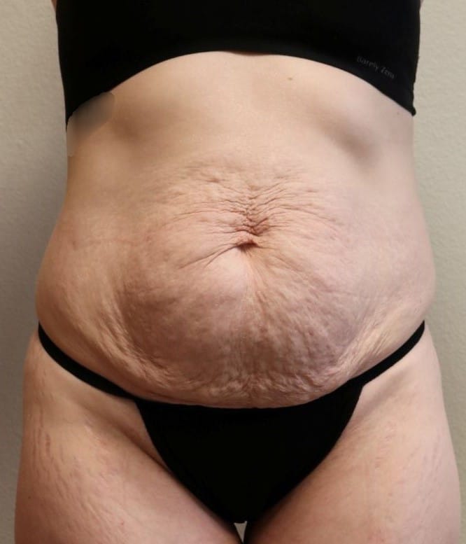 Before Image: Abdominoplasty – Fort Worth, Texas - front