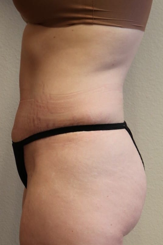After Image: Abdominoplasty – Fort Worth, Texas - left-side