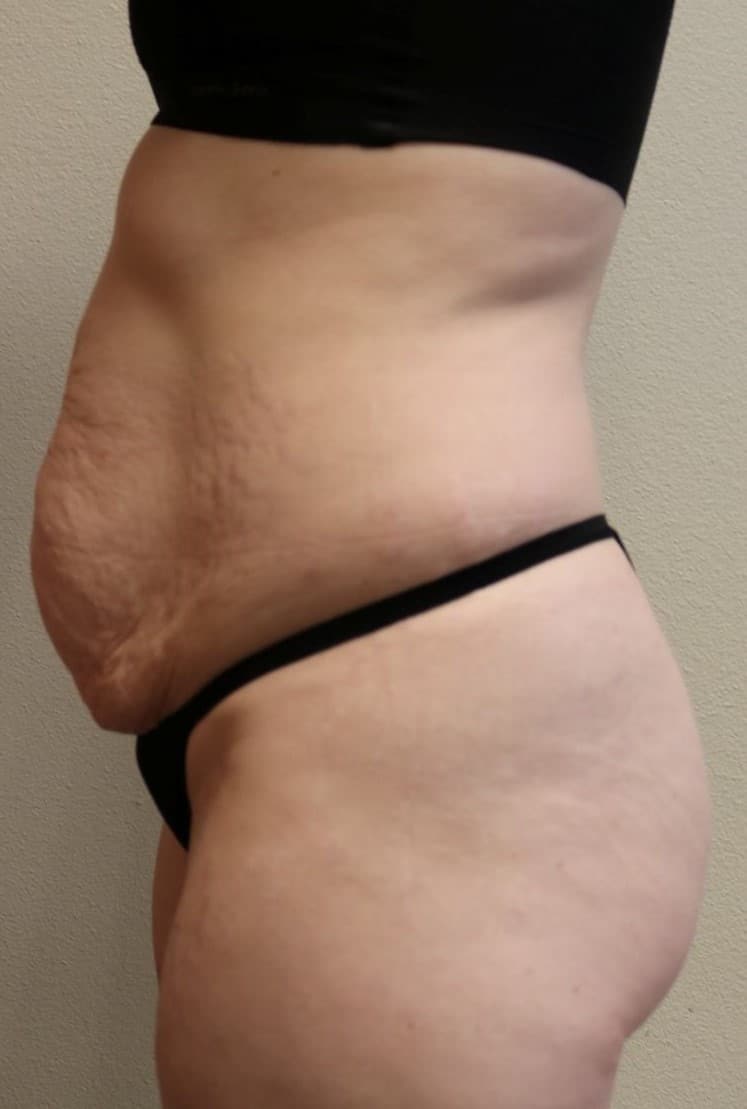 Before Image: Abdominoplasty – Fort Worth, Texas - left-side