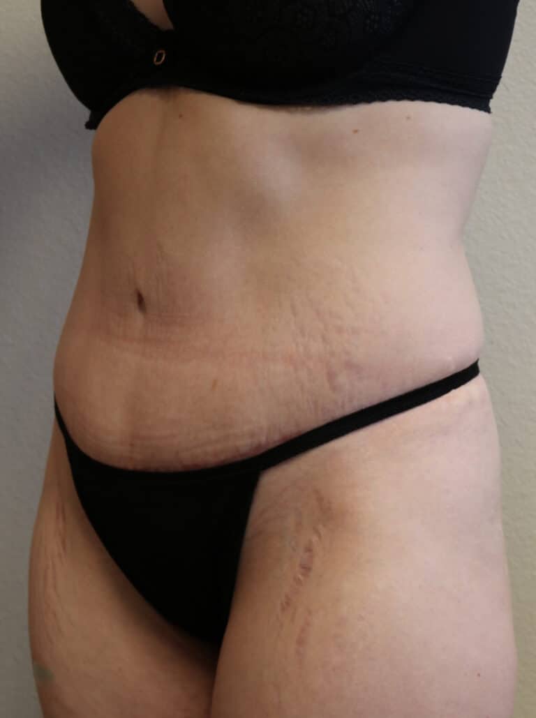 After Image: Abdominoplasty – Fort Worth, Texas - left-front-oblique
