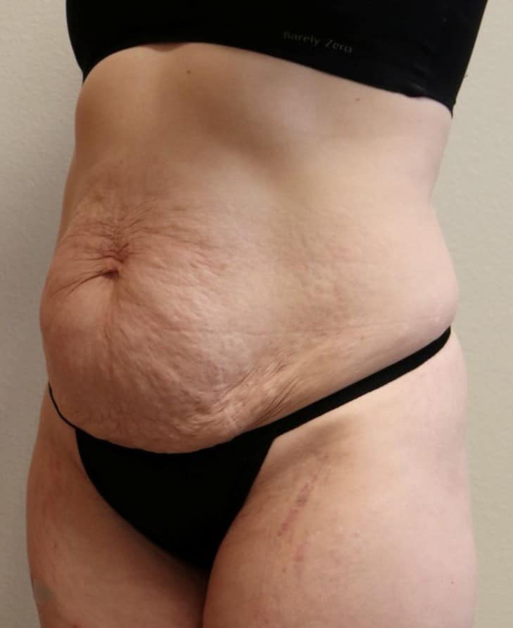 Before Image: Abdominoplasty – Fort Worth, Texas - left-front-oblique