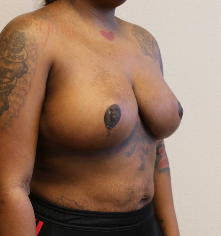 After Image: Breast Reduction – Fort Worth -