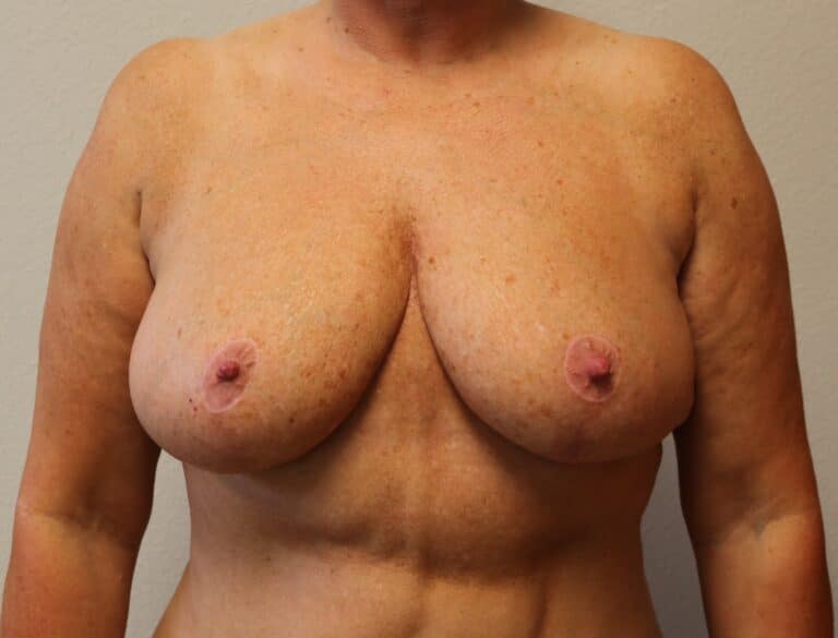 After Image: Breast Reduction – Fort Worth - front
