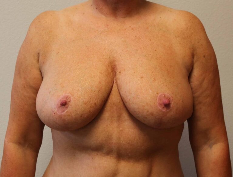 After Image: Breast Reduction – Fort Worth - front