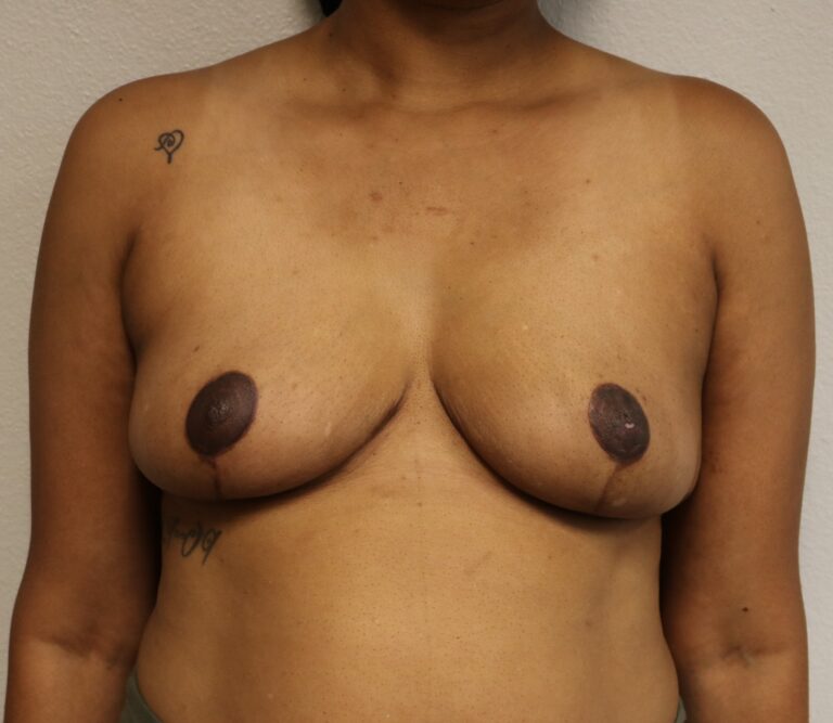 After Image: Breast Reduction – Fort Worth - front