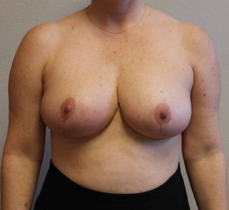 After Image: Breast Reduction – Fort Worth - front