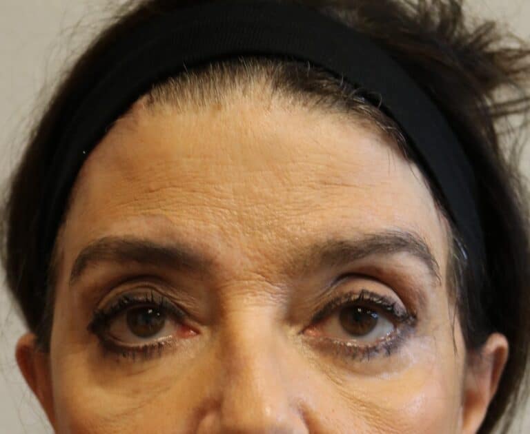 After Image: Brow Lift – Fort Worth - front