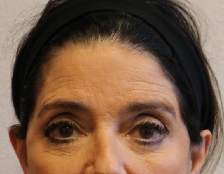 Before Image: Brow Lift – Fort Worth - front