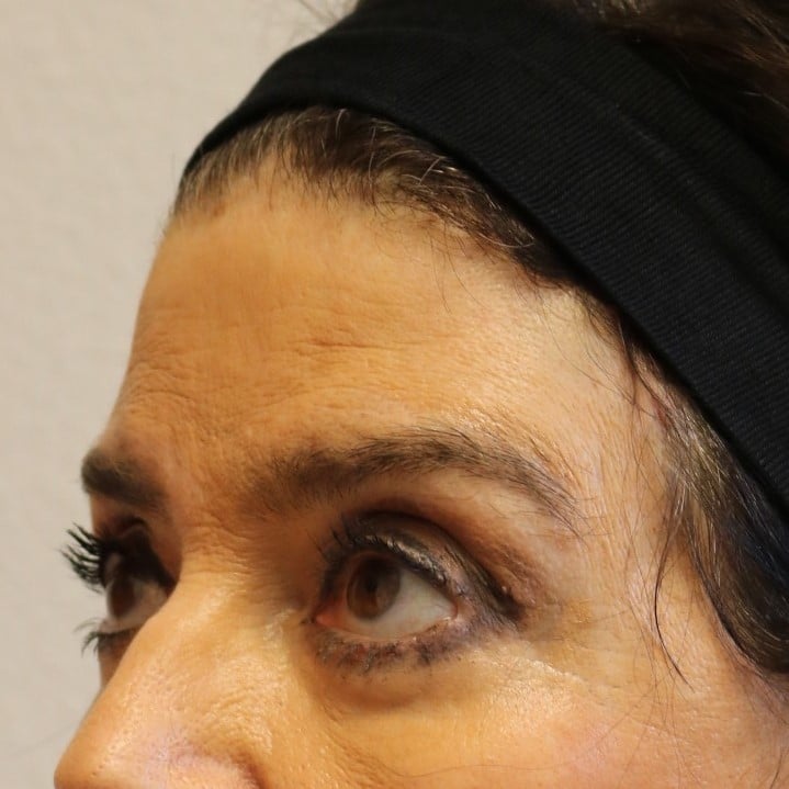 After Image: Brow Lift – Fort Worth - left-front-oblique