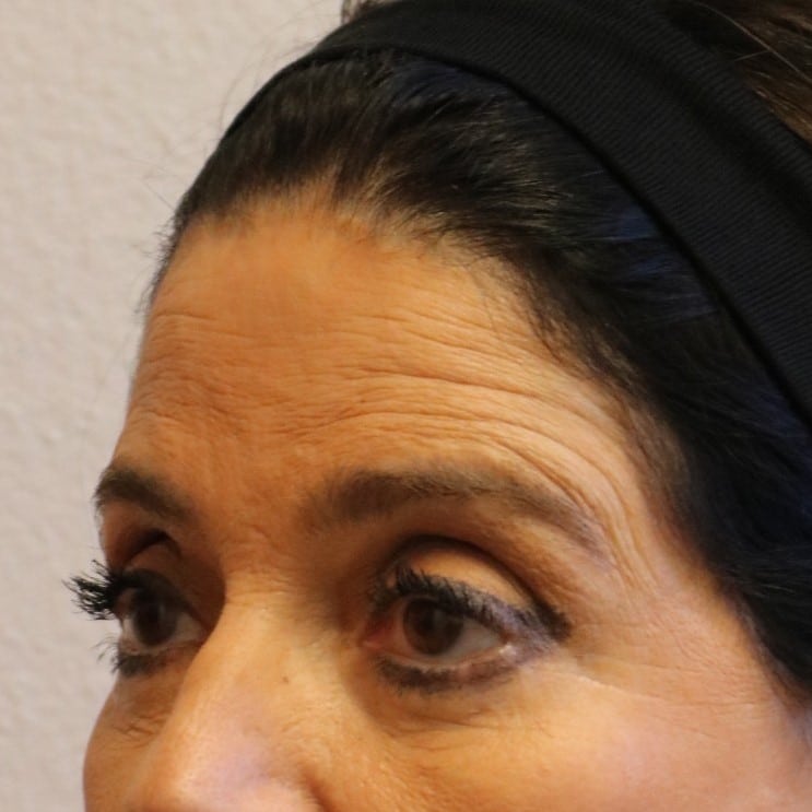 Before Image: Brow Lift – Fort Worth - left-front-oblique