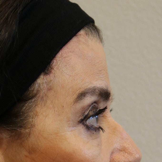 After Image: Brow Lift – Fort Worth - right-side