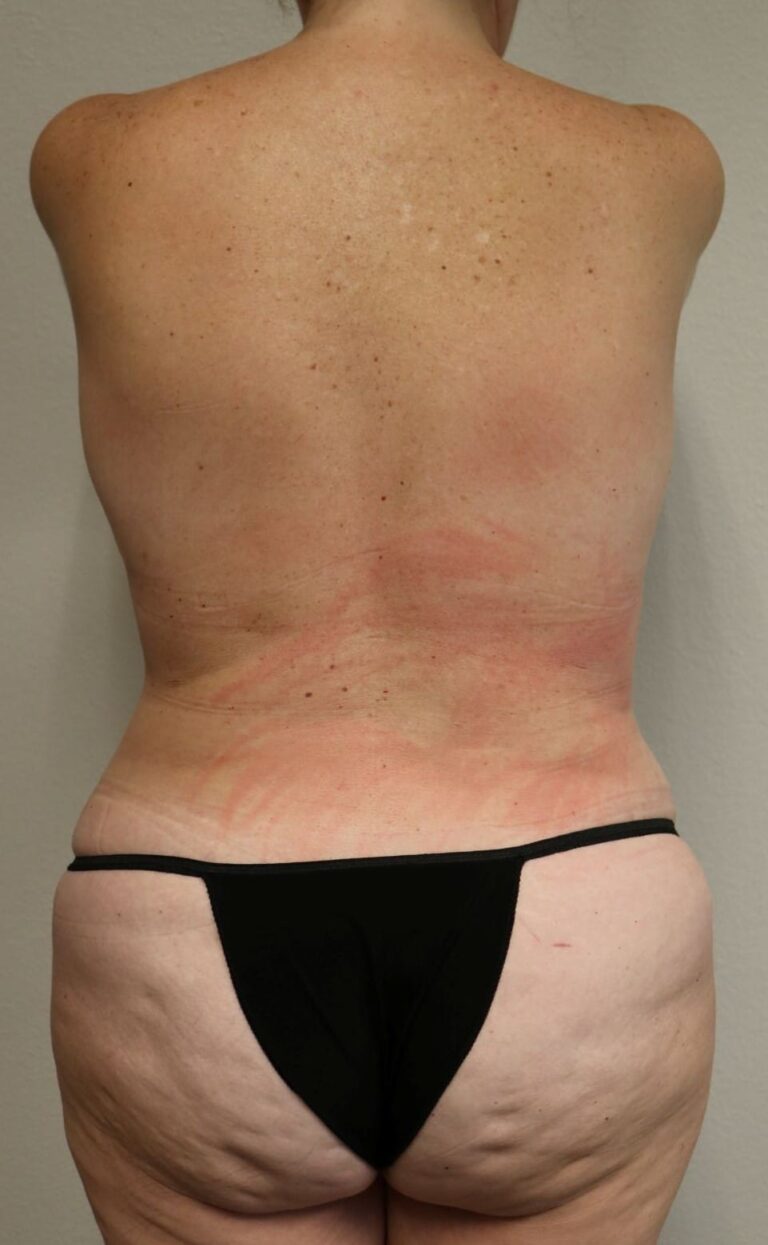 After Image: Tummy Tuck - back