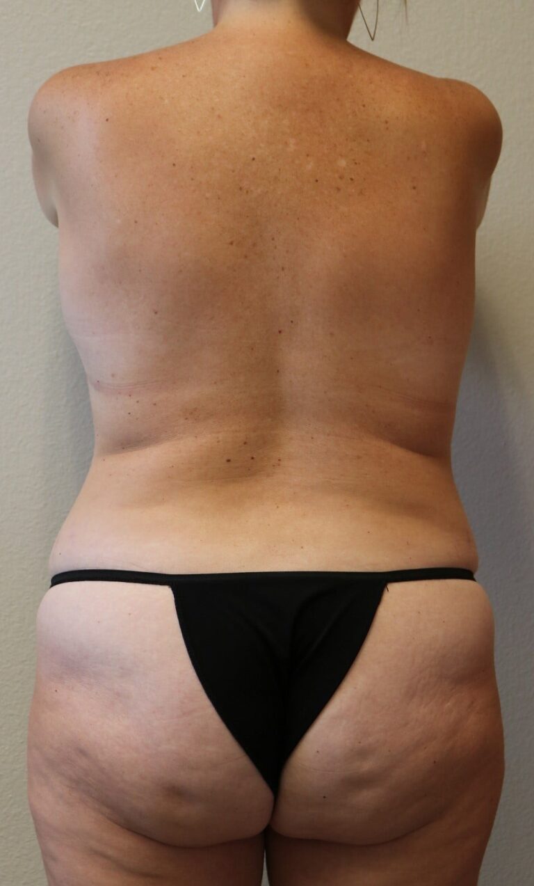 Before Image: Tummy Tuck - back
