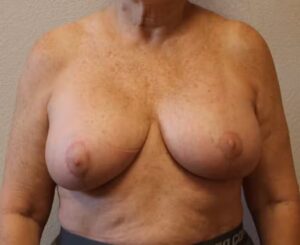 After Image: Breast Revision – Fort Worth