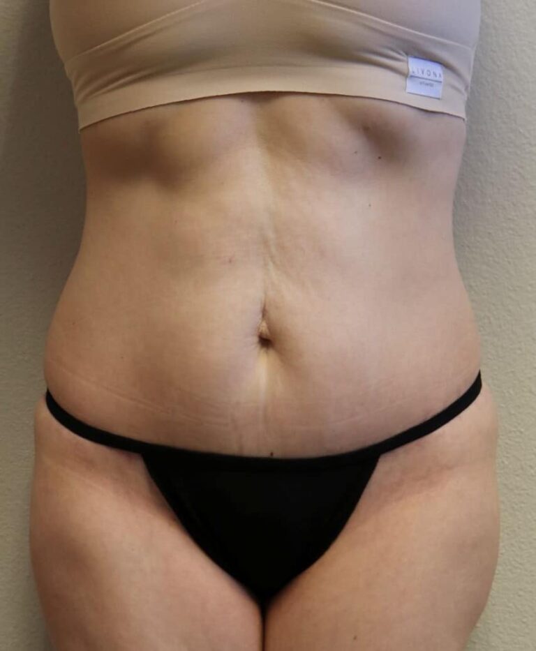 After Image: Tummy Tuck - front