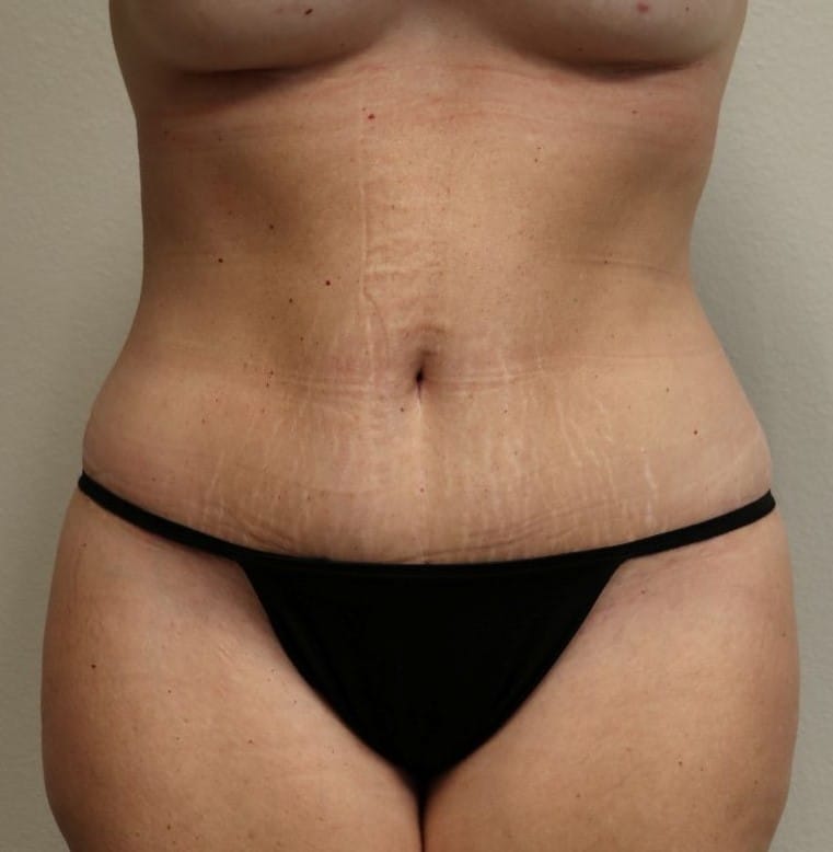 After Image: Tummy Tuck - front