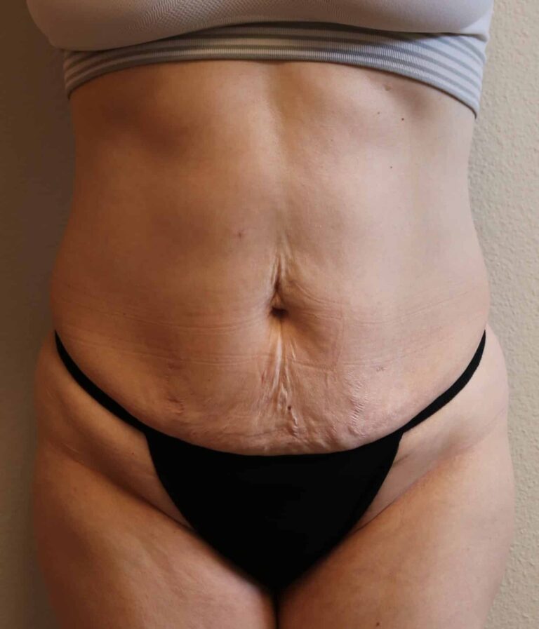 Before Image: Tummy Tuck - front