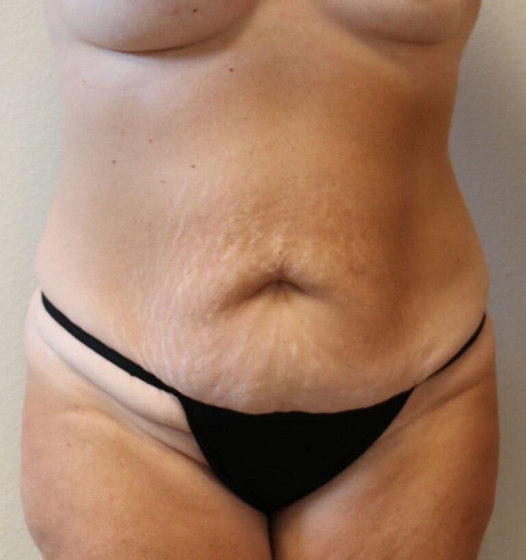 Before Image: Tummy Tuck - front