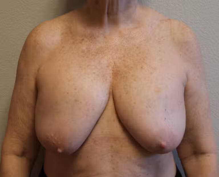 Before Image: Breast Revision – Fort Worth - front