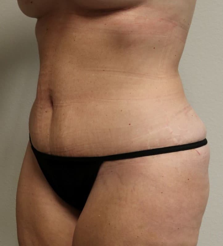 After Image: Tummy Tuck - left-front-oblique