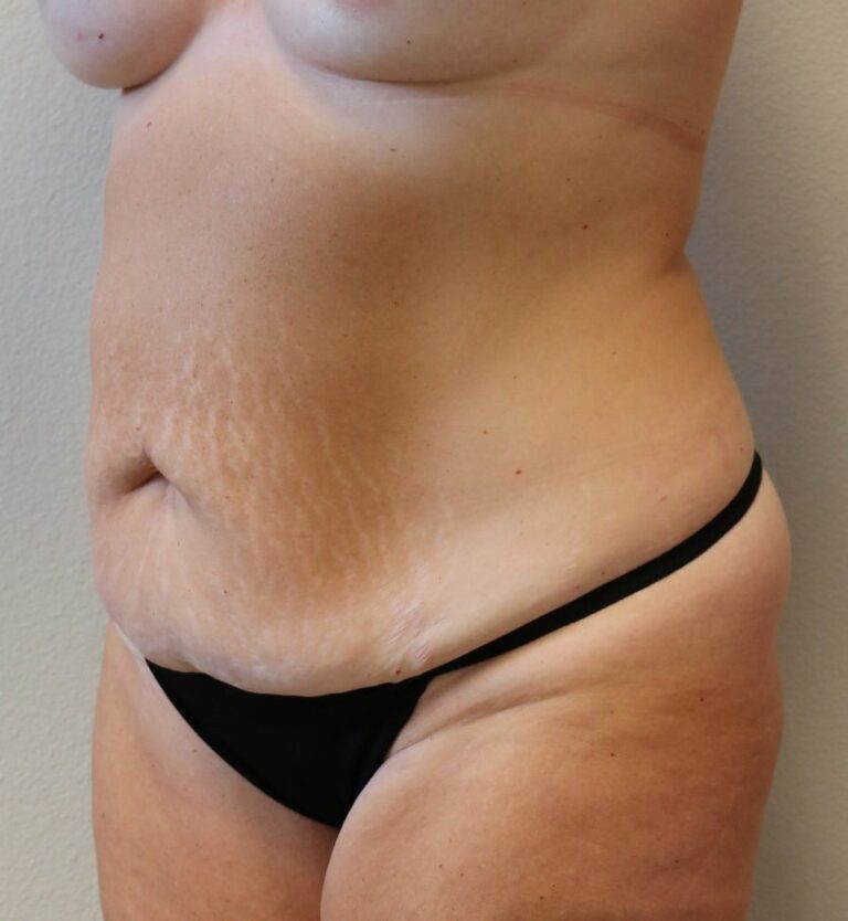 Before Image: Tummy Tuck - left-front-oblique