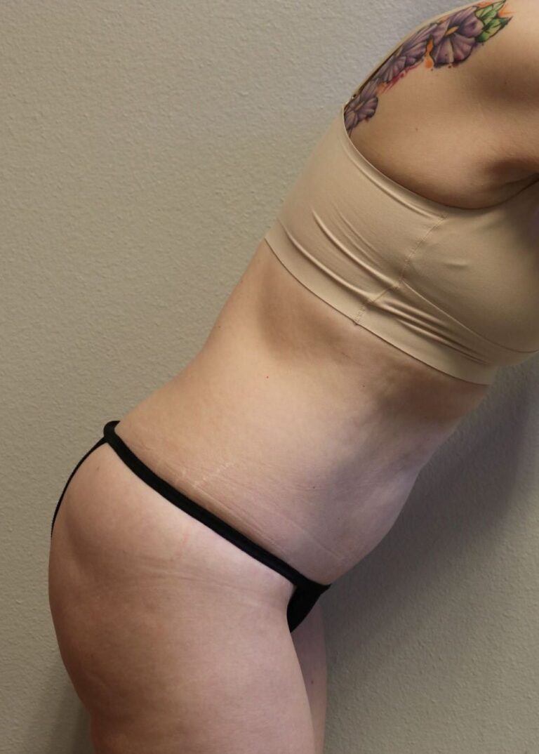 After Image: Tummy Tuck - other