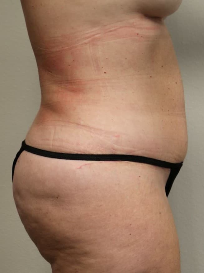 After Image: Tummy Tuck - right-side