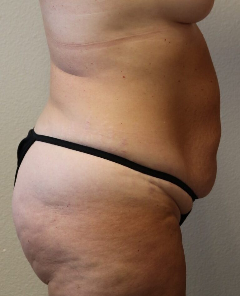 Before Image: Tummy Tuck - right-side
