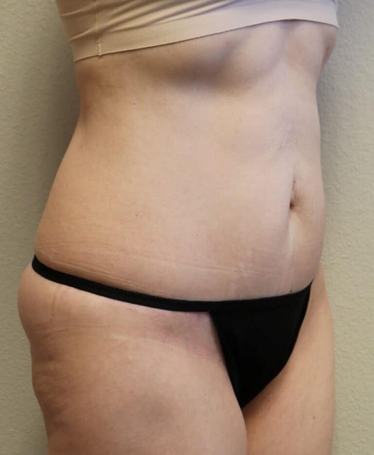 After Image: Tummy Tuck - right-front-oblique