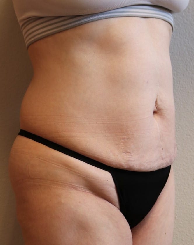 Before Image: Tummy Tuck - right-front-oblique