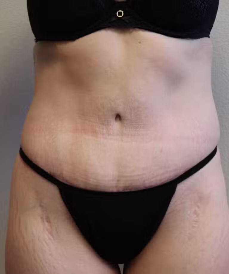 After Image: Tummy Tuck - front