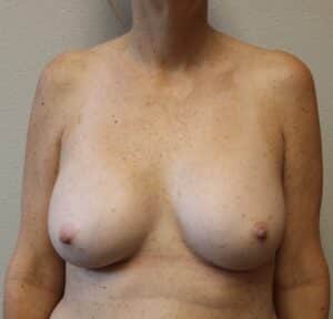 After Image: Ruptured Breast Implant – Fort Worth