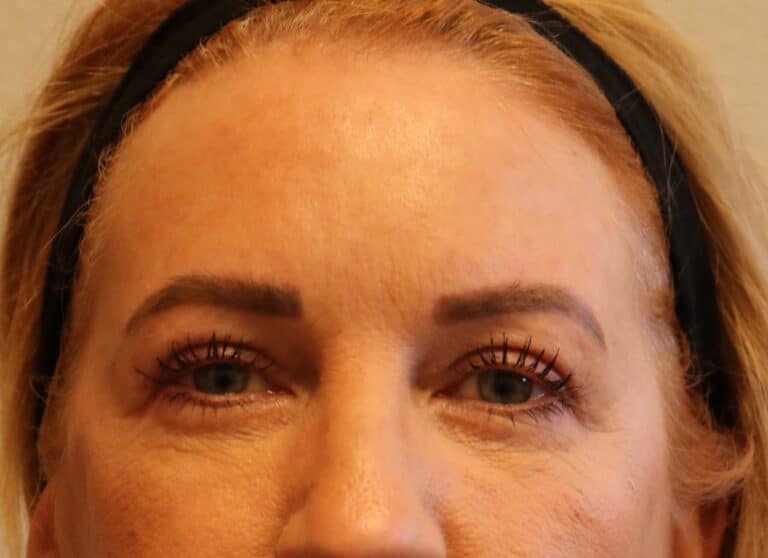 After Image: Upper Blepharoplasties – Fort Worth - front