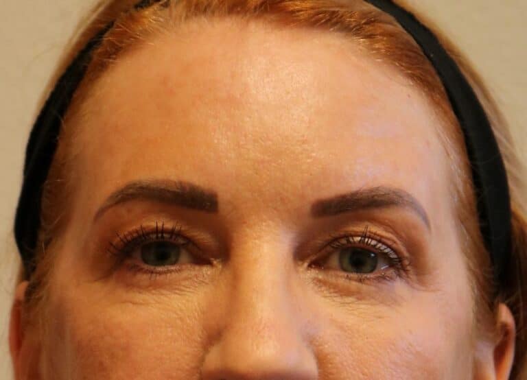 Before Image: Upper Blepharoplasties – Fort Worth - front