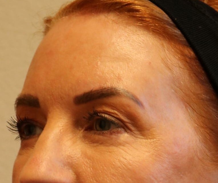 Before Image: Upper Blepharoplasties – Fort Worth - left-front-oblique