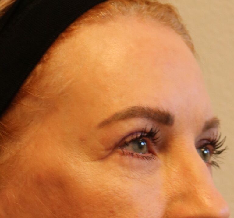 After Image: Upper Blepharoplasties – Fort Worth - right-front-oblique